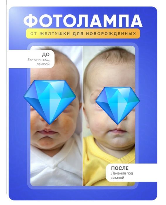 Фотолампа от желтушки