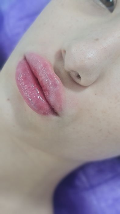 Губы, Ботокс, Филлеры