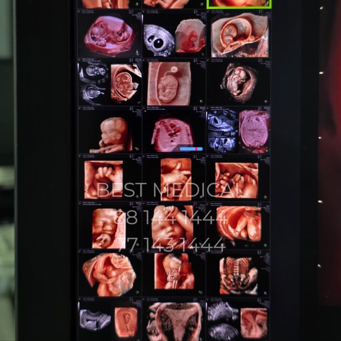 Узи аппарат GE Voluson E10