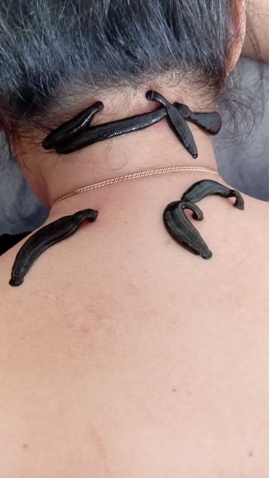 Постановка пиявок