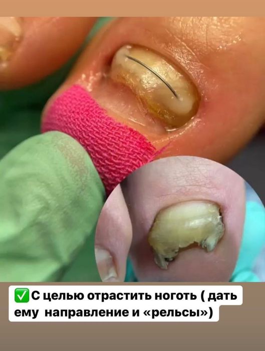 Лечение и исправление вросших ногтей.  Падолог