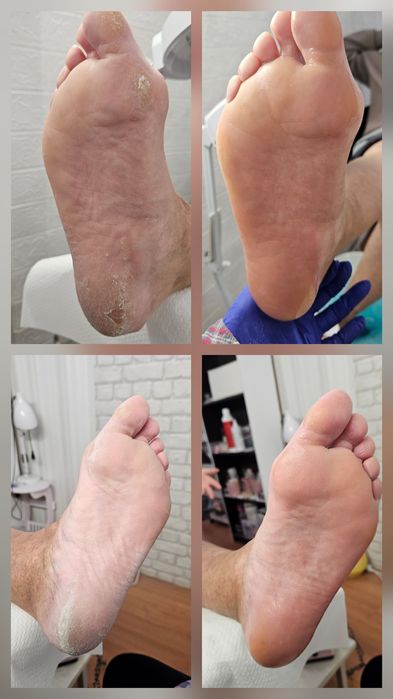 Pedichiură clasică și medicală