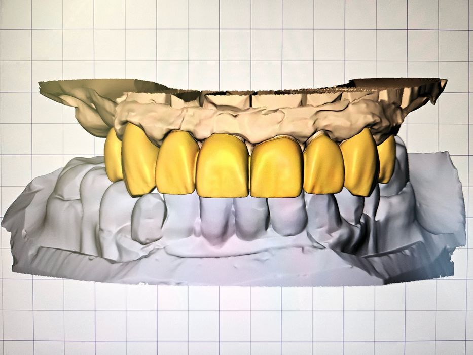 Дигитален Дизайн на Зъбопротезни конструкции от Зъботехник чрез Exocad