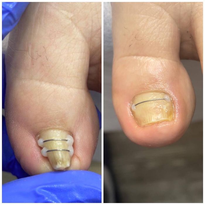 Лечение и исправление вросших ногтей.  Падолог