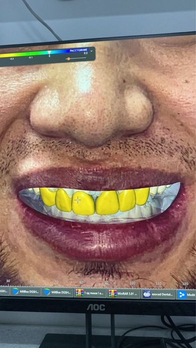 Импланты от 49.999.