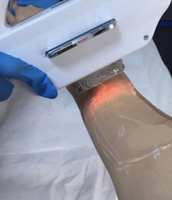 SHR si IPL  E- Light  Aparat de Epilare Definitivă