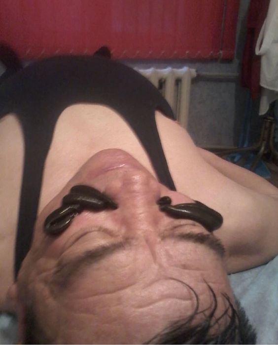 Хиджама, Гирудотерапия (сүлік салу емі)