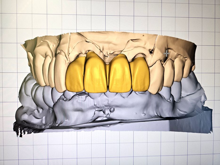 Дигитален Дизайн на Зъбопротезни конструкции от Зъботехник чрез Exocad