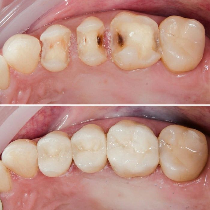 Лечение кариеса без боли!