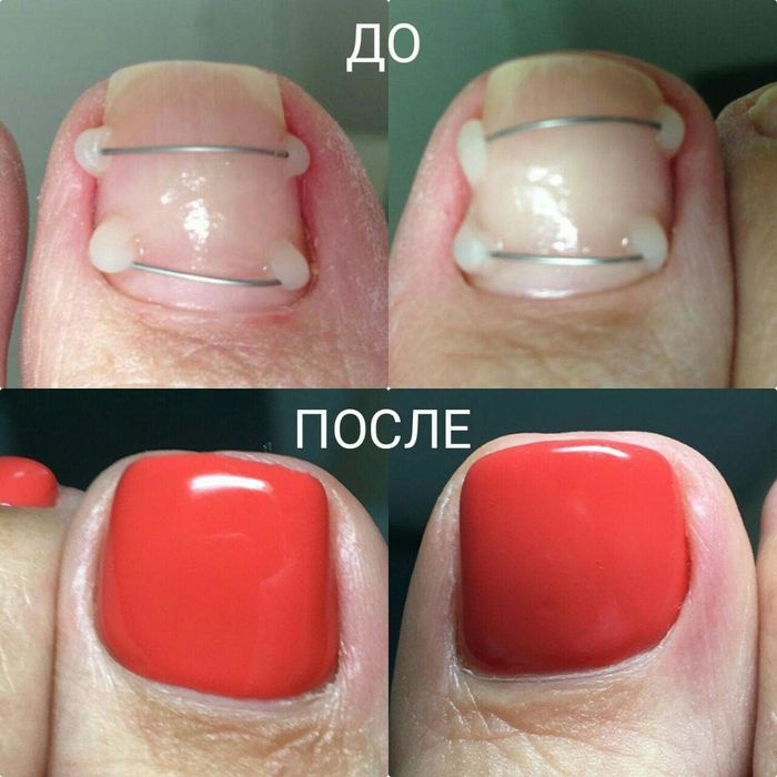 Педикюр титановая нить подолог