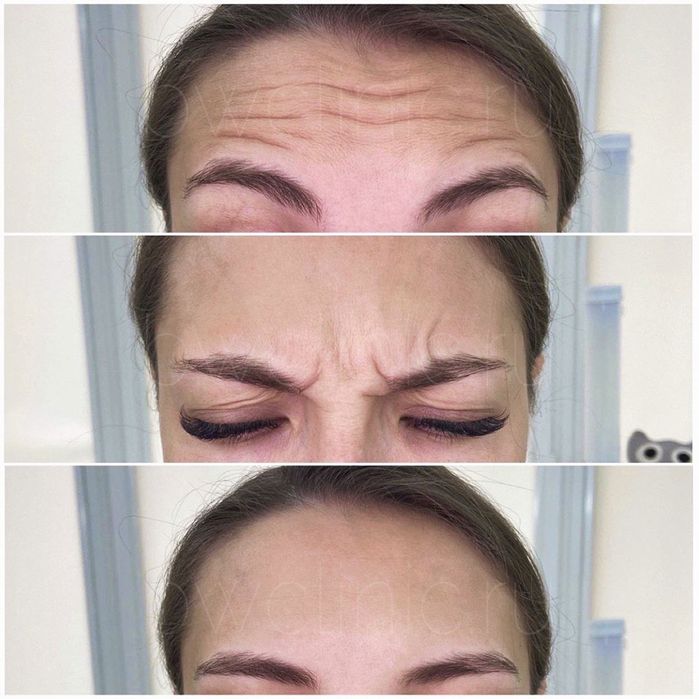 Ботокс мезаботокс фуллфейс