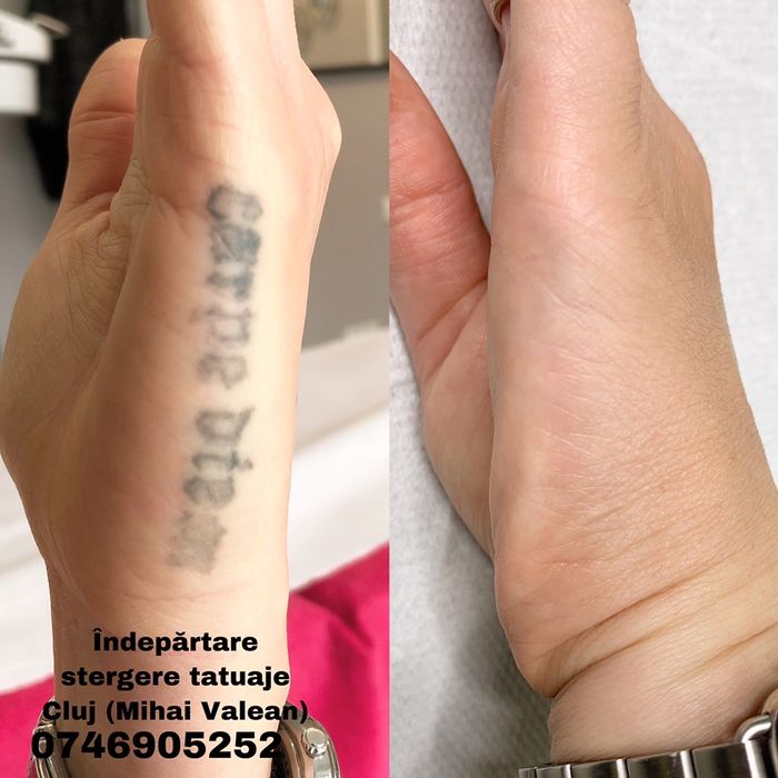 Tatuaj cosmetic , Microblading si Eliminare Tatuaje cu Laser