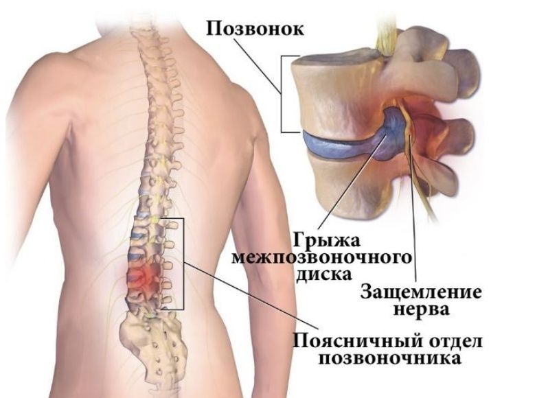 Грыжа, шертпе, хижама ,остеохондроз, артроз, головокружение,