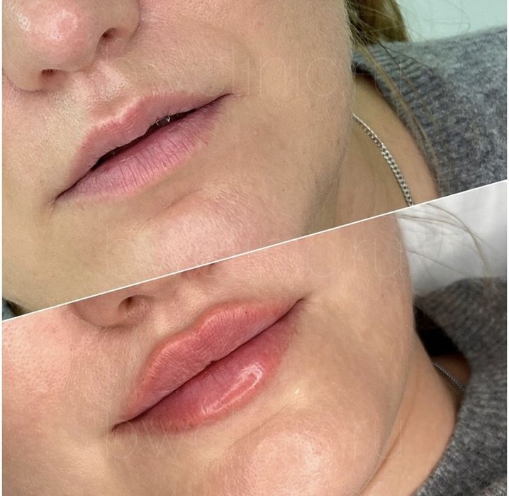 Акция Увелечение губ