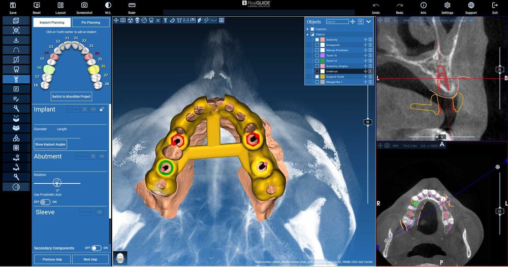 Realguide 5.4.2 + ImplantStation 5.3.2 + BlueSkyPlan + ImplantStudio