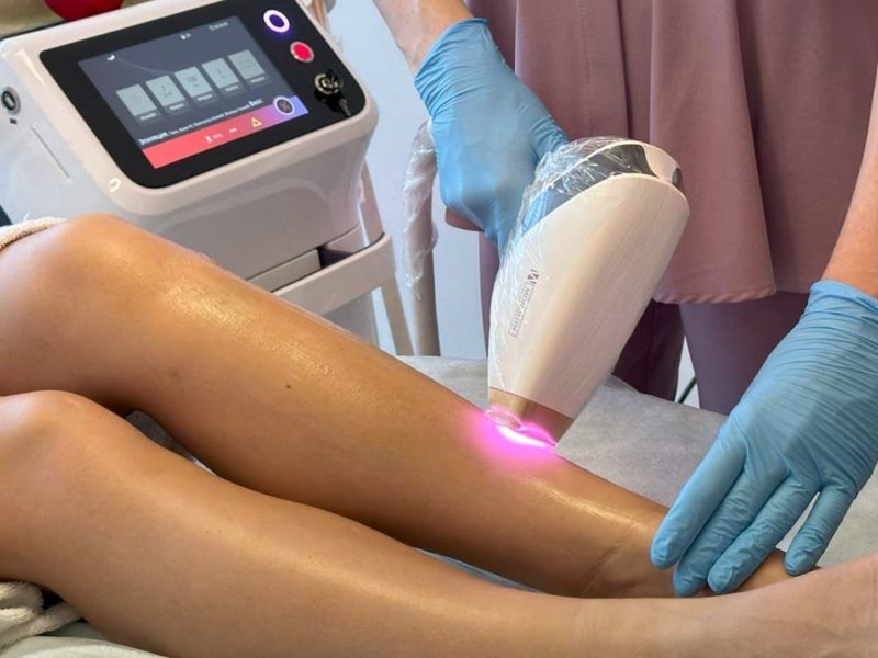 Лазерная эпиляция волос
