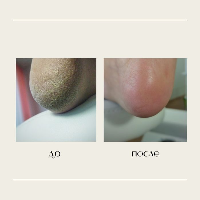 Педикюр, подолог