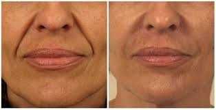 Коррекция носогубных складок филлерами в Ташкенте