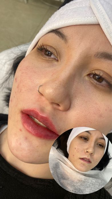 Акция губы, ботокс, чистка, плазма