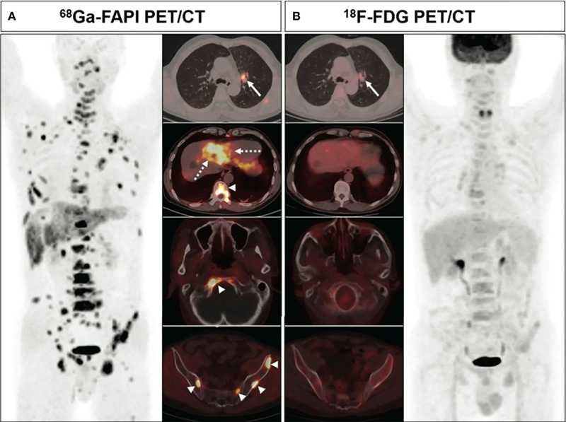 Позитрон-эмиссия томографияси (ПЭТ - КТ)