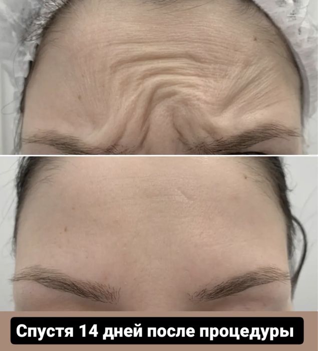 Плазмолифтинг - 7990