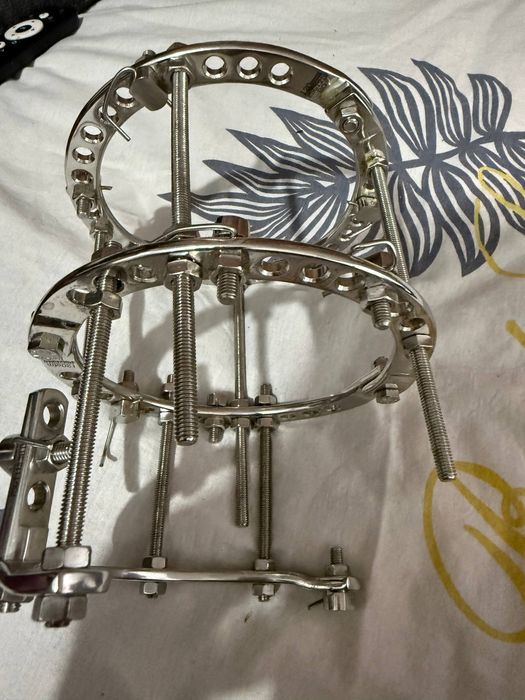 Аппарат илизарова пара, apparat ilizarova