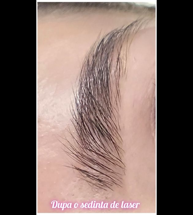 Îndepărtare tatuaj sprâncene și corp | Laser | PMU/Microblading