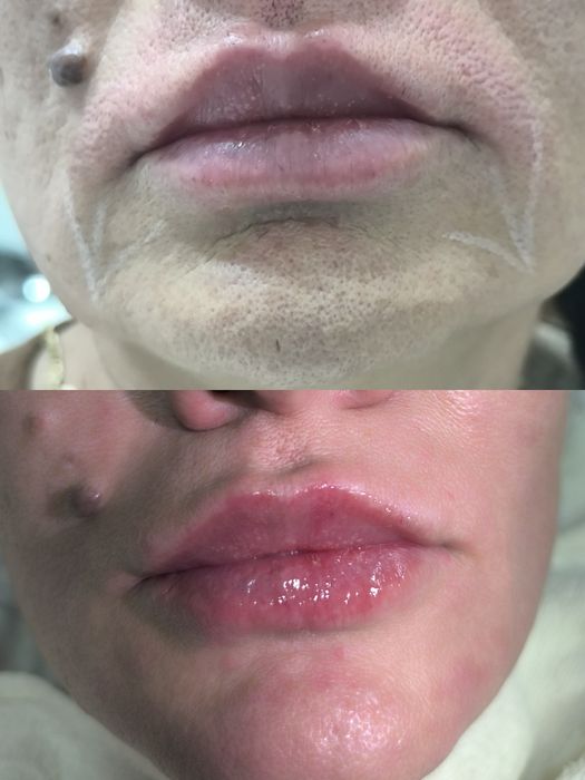 Красота это -губки бантиком на новый год! Botox full face