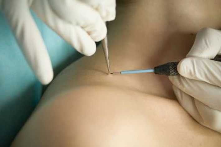 Удаление папиллом, электрокоагуляция и лазер. Papilloma yo'qotish.