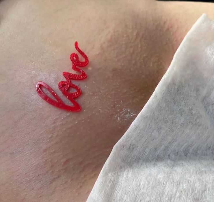 Лазерная эпиляция/Удаление татуажа