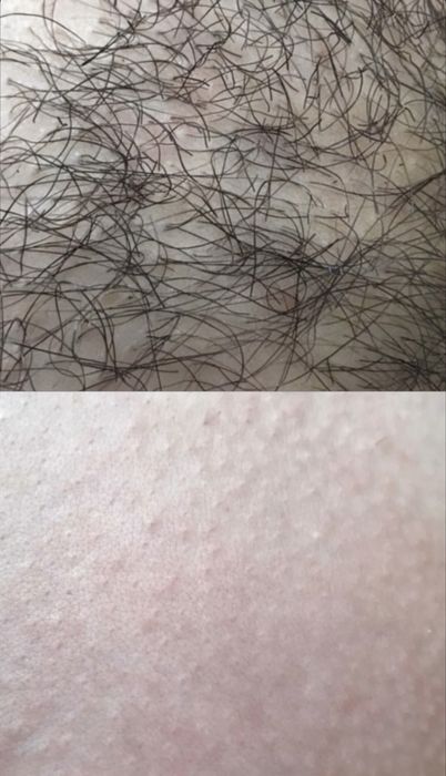 Мужская депиляция