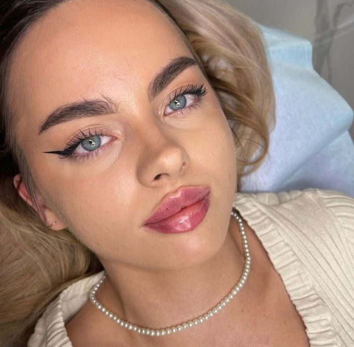 Adio buze mici,volumizare buze cu acid hialuronic