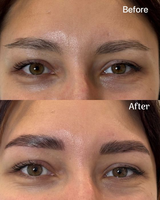 Laminare gene si sprancene