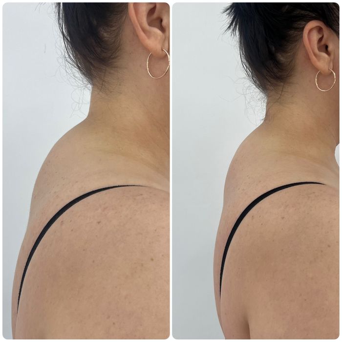 Ультраформер, косметологический аппарат