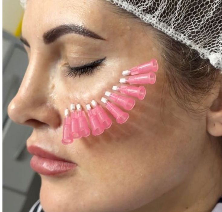 Лабга филлер ботекс