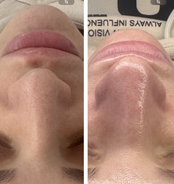 Процедура комбинировпнной чистки лица