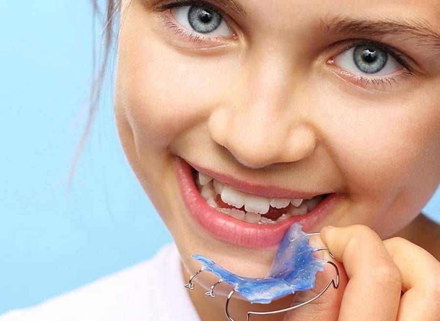 Болаларда тишларни брекет билан даволаш