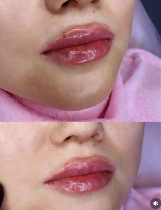 Хиджама / Косметолог/ 10 лет стаж