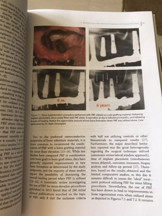 Platelet Rich Fibrin in Regenerative Dentistry 2017