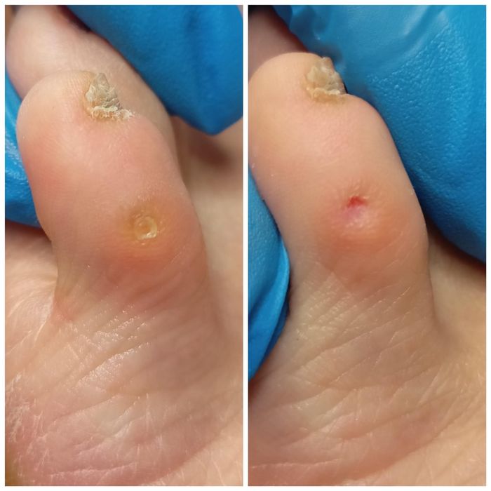 Pedichiură Medicală