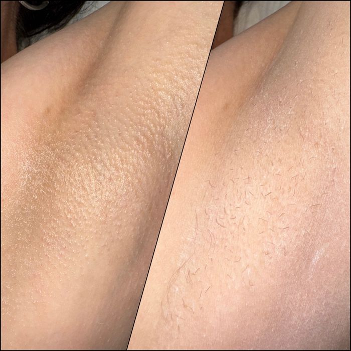 Профессиональная депиляция шугаринг, полимерный воск