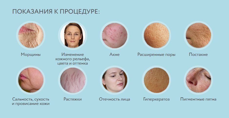 Аквапилинг