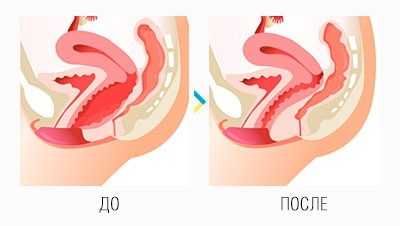 Интимное омоложение. Безоперационное лазерное интимное сужение.