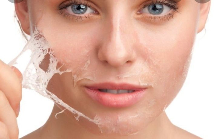 Химический пилинг