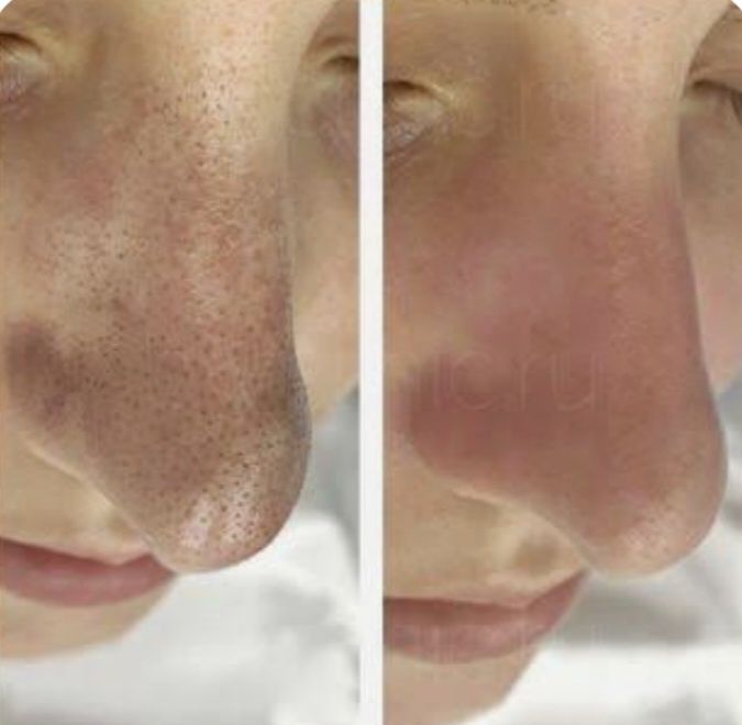 Yuzni chishtka qilish. Глубокая чистка лица