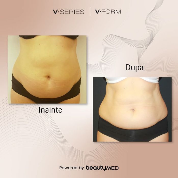 Vânzare aparat remodelare corporala Viora V10