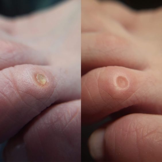 Ичига усган тирнок,Подолог хизмати