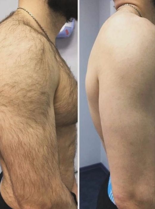 Мужская депиляция