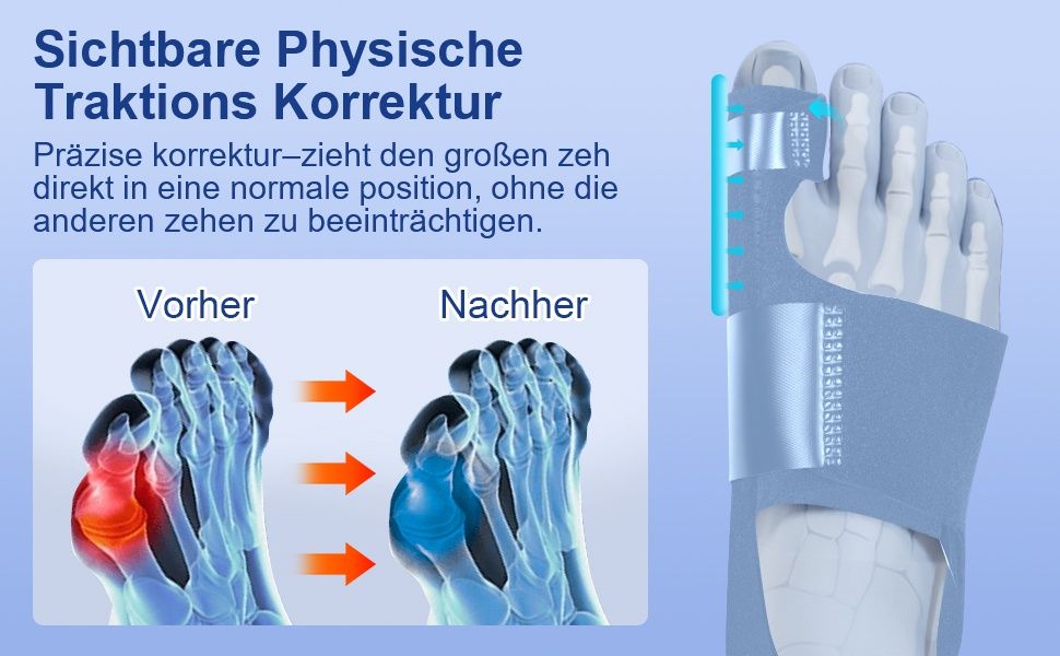 К-кт 2бр шина за корекция на изпъкнало кокалче Hallux Valgus