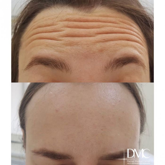 Ботокс,Губы в Ташкенте